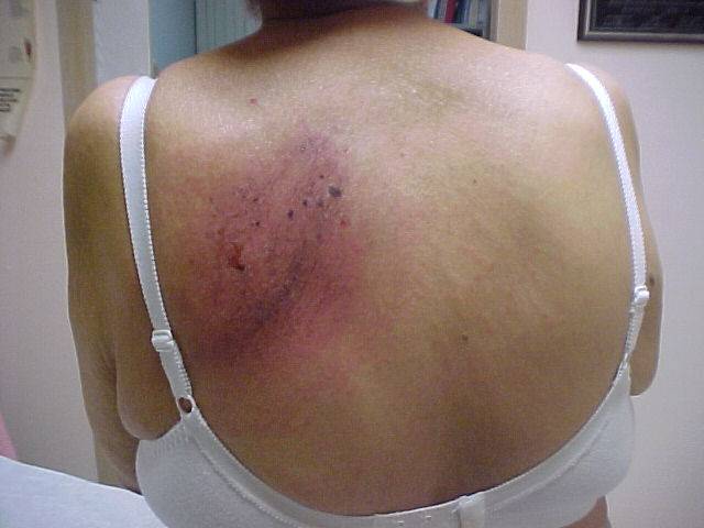Herpes zoster agudo y neuralgia post herpetica