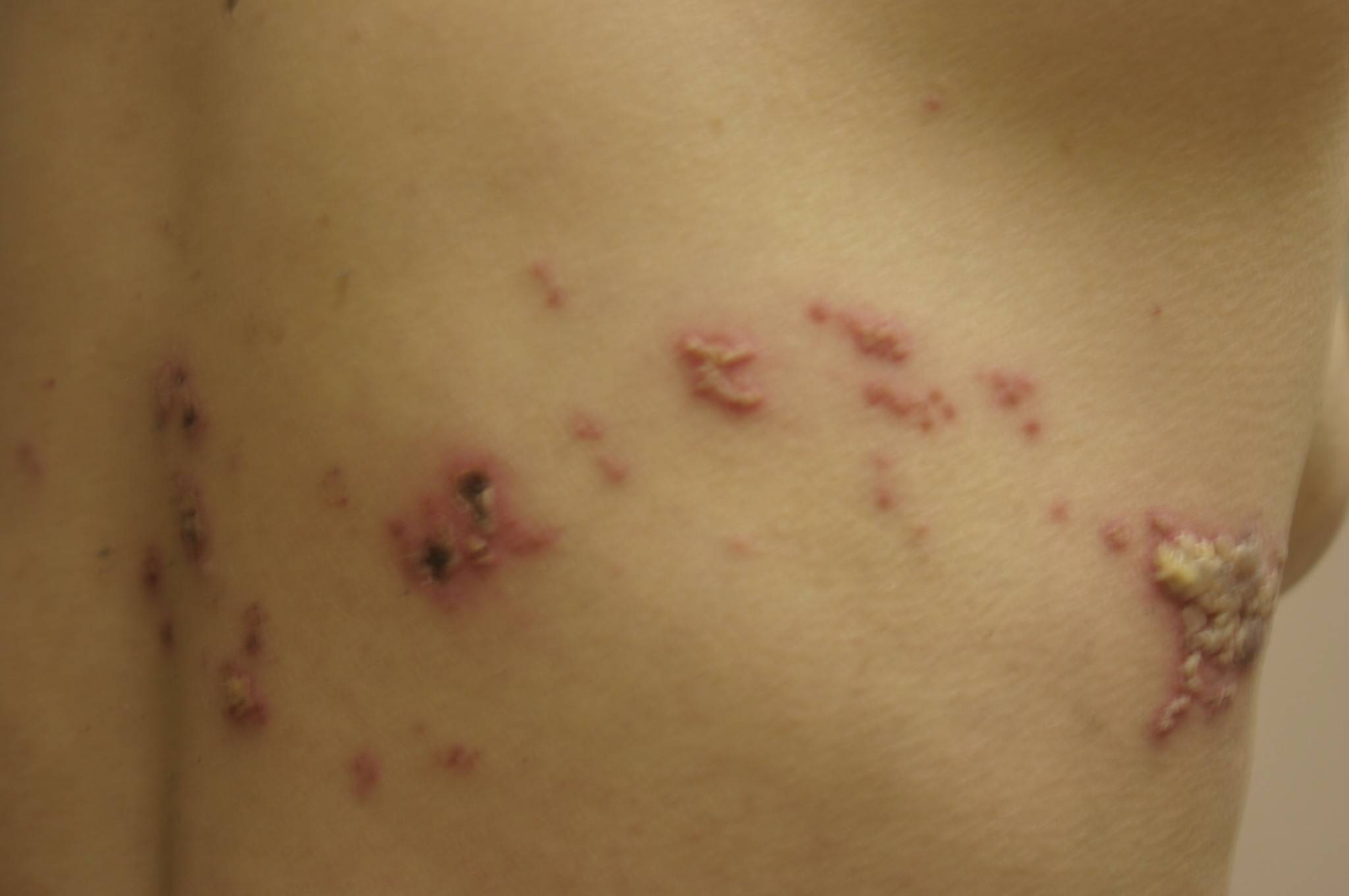 Herpes zoster agudo y neuralgia post herpetica